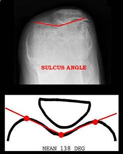 femoral condyle defect icd 10