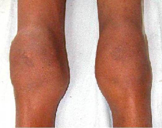Knee synovitis associated with