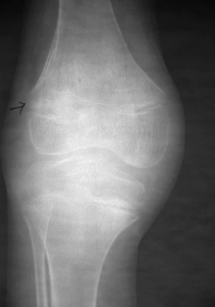 Anteroposterior radiograph of the knee in a patient with juvenile rheumatoid 