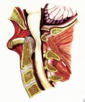 Atlantoaxial Dislocation