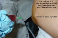 Olecranon bursitis aspiration of a hemorrhagic eff