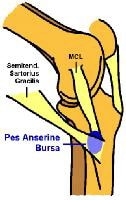 Location of pes anserine bursa on the medial knee.