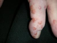 Finger Nodules