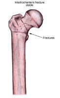 Plastic+bowing+fracture