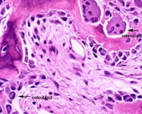 This image depicts bone remodeling with osteoclast
