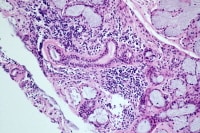 Photomicrograph of a lip biopsy specimen showing t