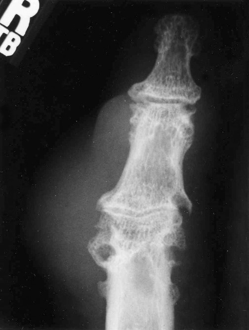 Gout. Radiograph of erosions with overhanging edg...