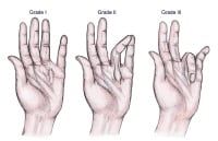 Three clinical grades of Dupuytren disease. 