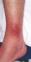 ankle rashes