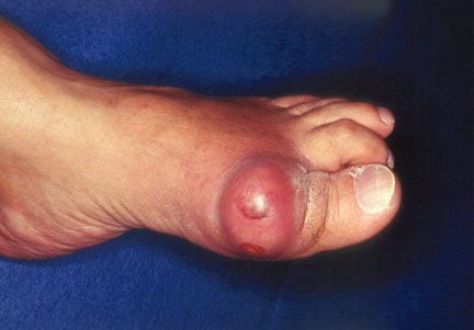 Gout. Acute podagra due to gout in an elderly man.