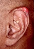 Gout. Tophaceous deposits in ear.