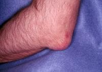 Gout. Tophaceous deposits on elbow.
