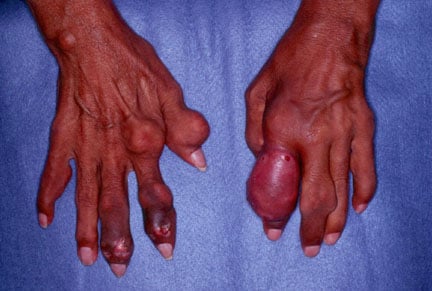 Gout. Chronic tophaceous gout in an untreated pat...