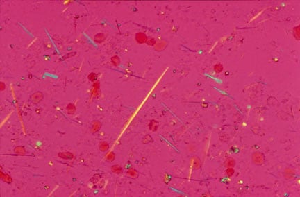 staphylococcus aureus gram stain. Also send for Gram stain, C+S,