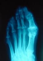 Gout. Plain radiograph showing typical changes of...