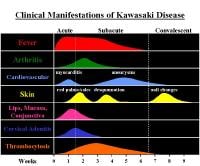 Clinical manifestations and time course of Kawasa...