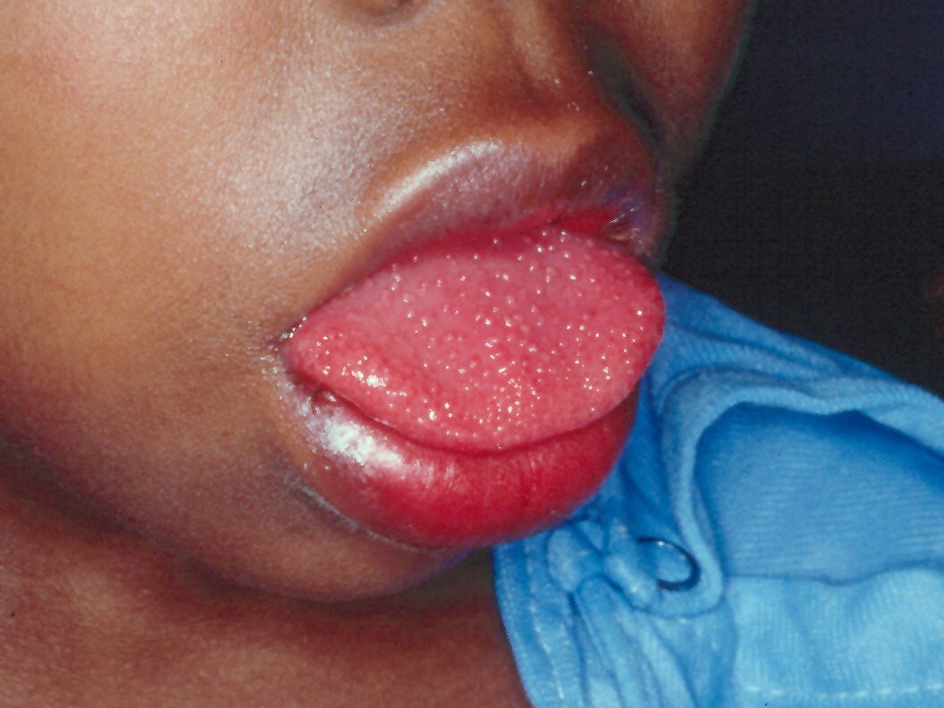 Oral manifestations of Kawasaki  disease: red lips...