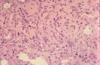 Diffuse lupus nephritis with hypertensive vascula...