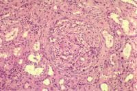 Diffuse lupus nephritis with early crescent forma...