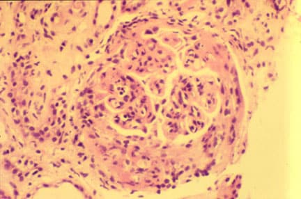Diffuse lupus nephritis with extensive crescent f...