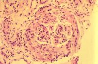 Diffuse lupus nephritis with extensive crescent f...
