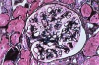 Membranous lupus nephritis showing thickened glom...