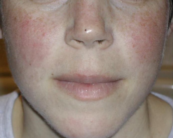 The classic malar rash, also known as a butterfly...