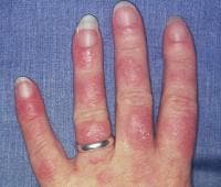 Systemic Arthritis Rash