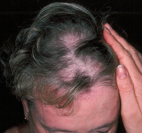 Dermatomyositis (DM) : 네이버 블로그