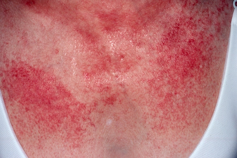 Dermatomyositis - Wikipedia