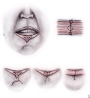 Steps to repair lip laceration. A 3-layered approa