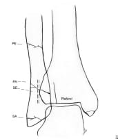 Diagram showing the typical locations for ankle fr