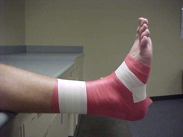 Ankle taping and bracing. Anchor strips. Note the placement of tape along 