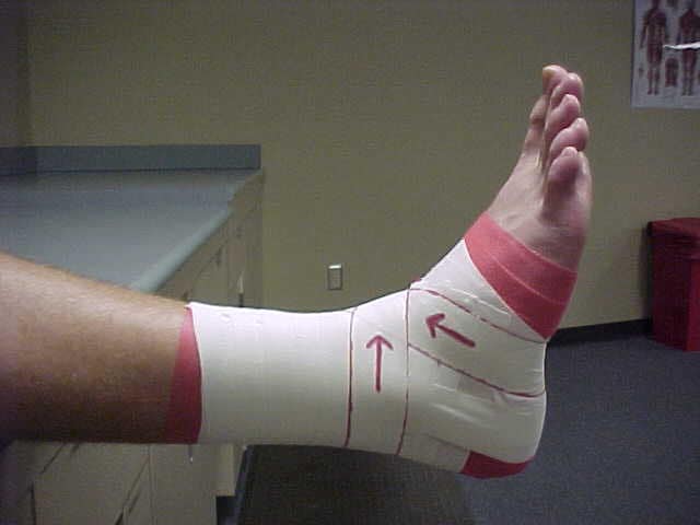 Ankle taping and bracing. Figure of 8.