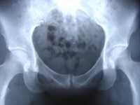 Radiograph in 19-year-old athlete who presented wi