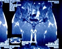 Magnetic resonance image (MRI) from 20-year-old Na