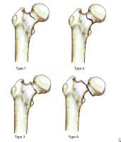 Femoral Fracture Classification