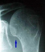 In this patient's shoulder radiography, the humera