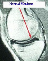 Magnetic resonance imaging scan showing a normal m