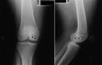 Anteroposterior and lateral radiographs of medial 