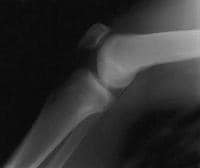 A normal lateral radiograph of a knee. In a normal
