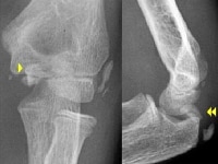 Medial epicondylar fracture 