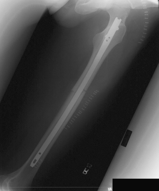 X-ray film of femur fracture repair.