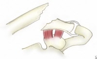 A type II distal clavicle fracture. In type IIA, b