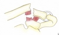 A type IIB fracture of the distal clavicle. The co