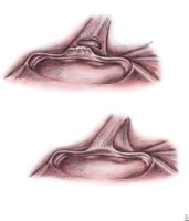 Upper left - Type III superior labrum anterior pos
