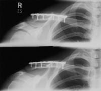 Radiographs after open reduction and internal fixa