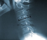 Lateral cervical spine plain radiograph illustrati