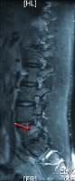 Long TR (T2-weighted) fat suppressed sagittal magn