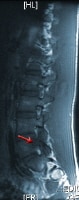 Sagittal short TR (T1-weighted) magnetic resonance